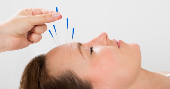 Acupuncture 
